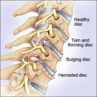 Management of Cervical Disc Bulge | Fit Clinic